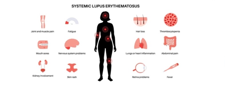 How dangerous a disease Lupus is. 8